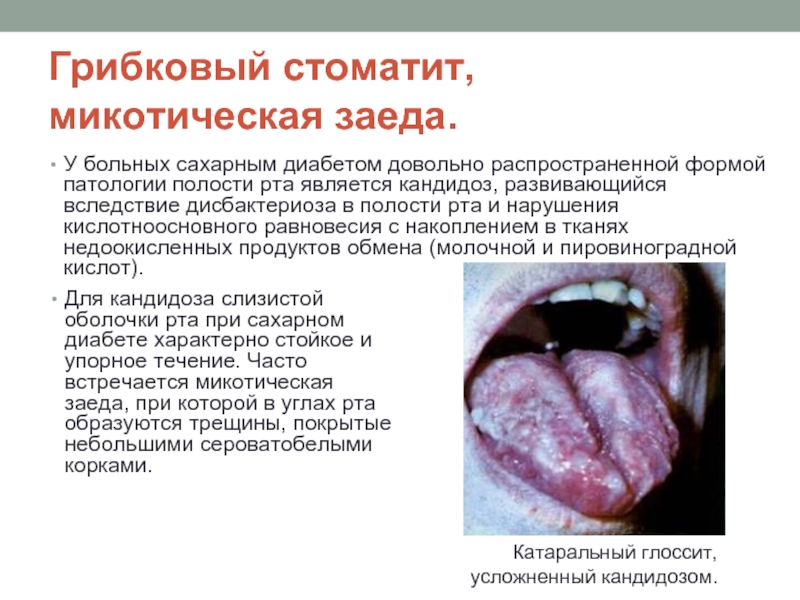 Реферат: Слизистая оболочка полости рта при заболеваниях эндокринной системы