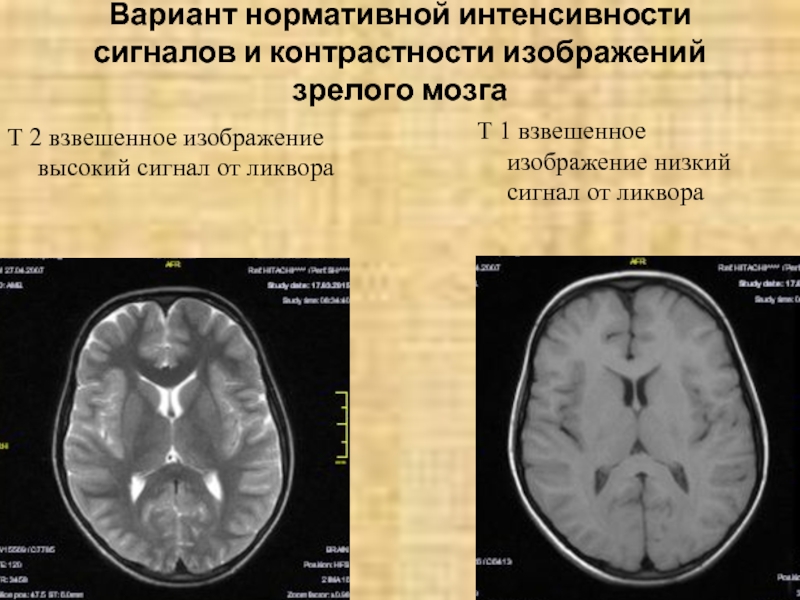 Очаги повышенной интенсивности