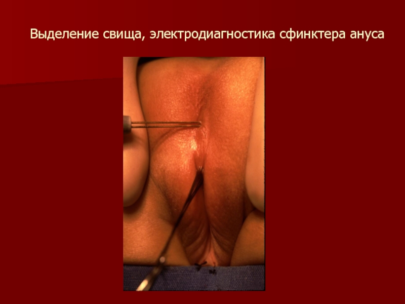 Выделение свища, электродиагностика сфинктера ануса