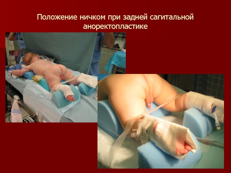 Положение ничком при задней сагитальной аноректопластике