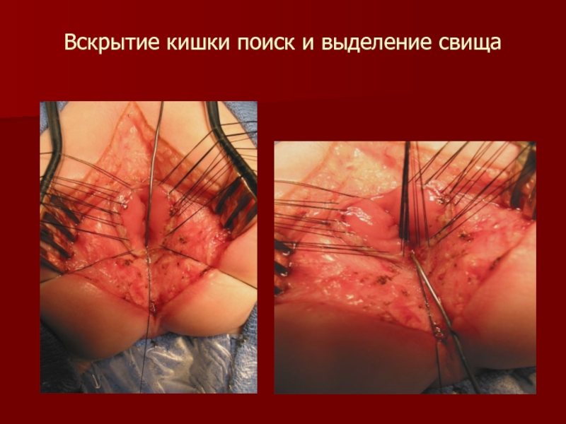 Вскрытие кишки поиск и выделение свища