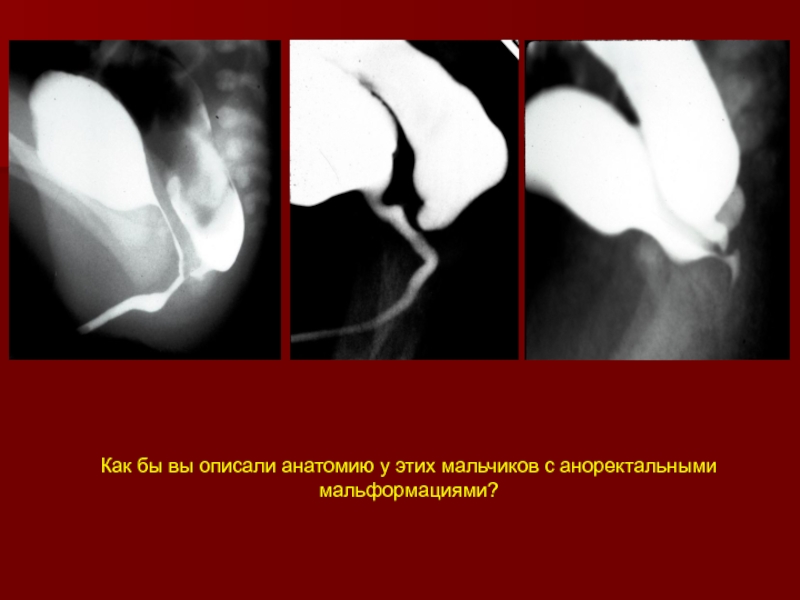 Как бы вы описали анатомию у этих мальчиков с аноректальными мальформациями?