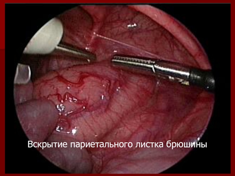 Вскрытие париетального листка брюшины