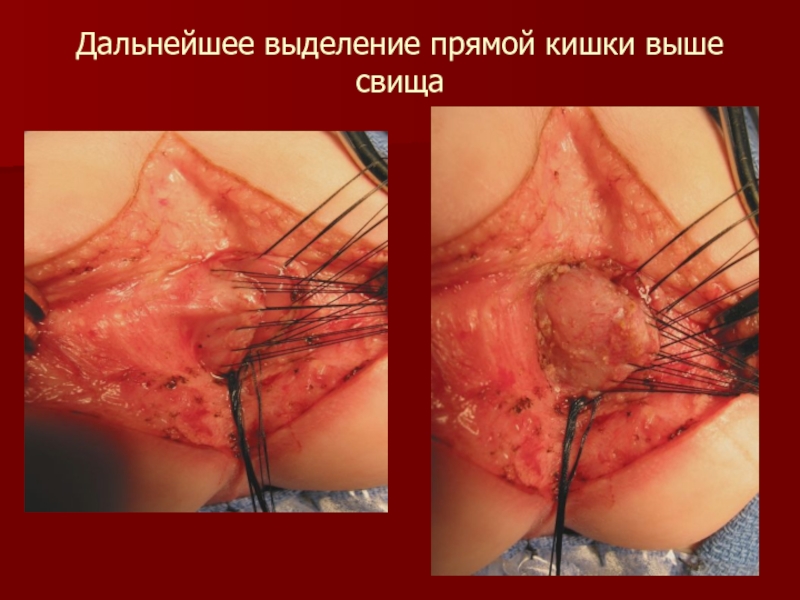 Дальнейшее выделение прямой кишки выше свища
