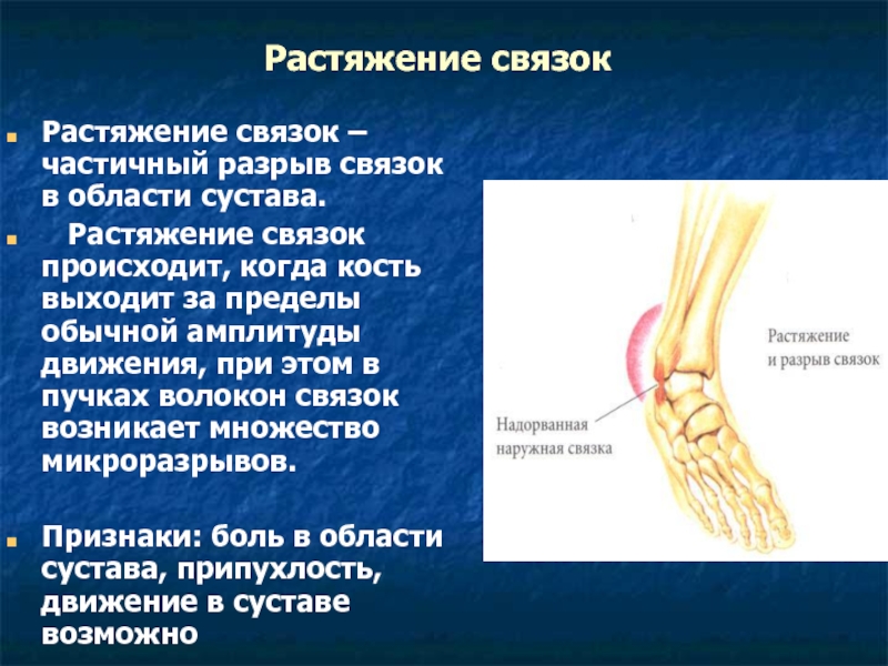 Повреждение коленной связки симптомы. Растяжение связоксвязок. Растяжения и разрывы связок суставов.