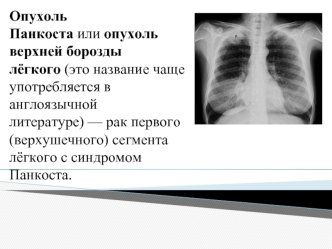 Опухоль Панкоста, или опухоль верхней борозды лёгкого