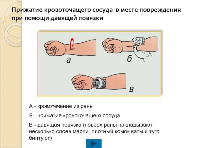 При венозном кровотечении накладывается давящая повязка