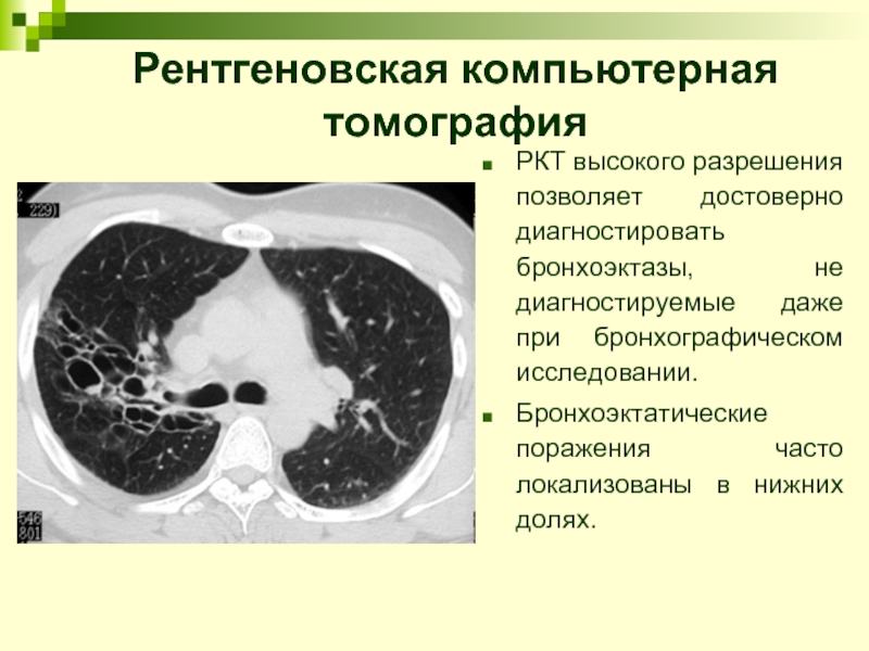 Рентгеновская компьютерная томография РКТ высокого разрешения позволяет достоверно диагностировать бронхоэктазы, не диагностируемые