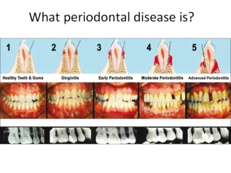 What periodontal disease is