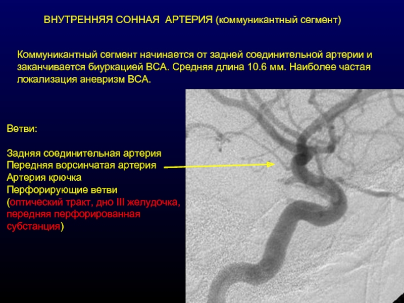 Аневризма сонной артерии что это. Отделы внутренней сонной артерии анатомия. Ветви каменистой части внутренней сонной артерии. С2 сегмент ВСА. Анатомия сифона внутренней сонной артерии.