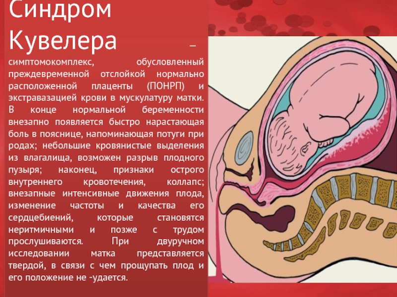 Матка кювеллера это