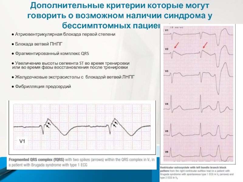 Синдром бругада презентация