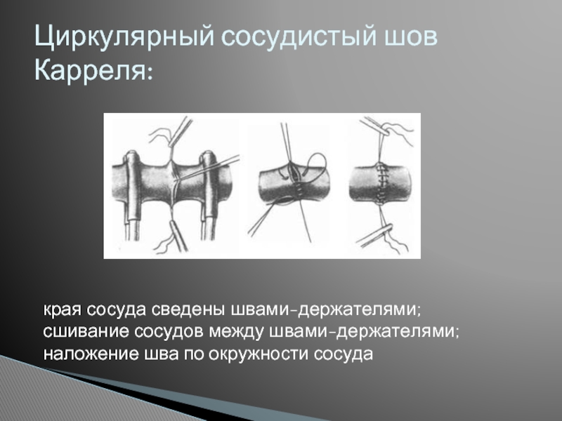 Сосудистый шов методы наложения. Сосудистый шов по Каррелю и Морозовой. Циркулярный сосудистый шов Карреля.