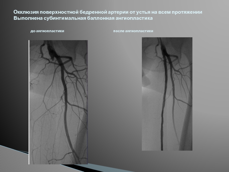 Окклюзия это. Окклюзия бедренной артерии. Атеросклероз поверхностной бедренной артерии. Посттромботическая окклюзия артерии. Тромботическая окклюзия.