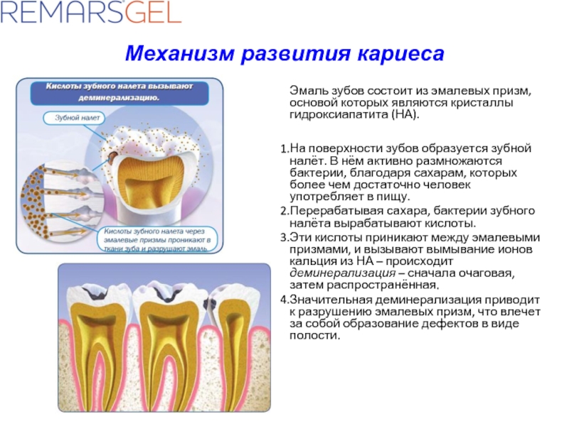 Механизм развития кариесаЭмаль зубов состоит из эмалевых призм, основой которых являются