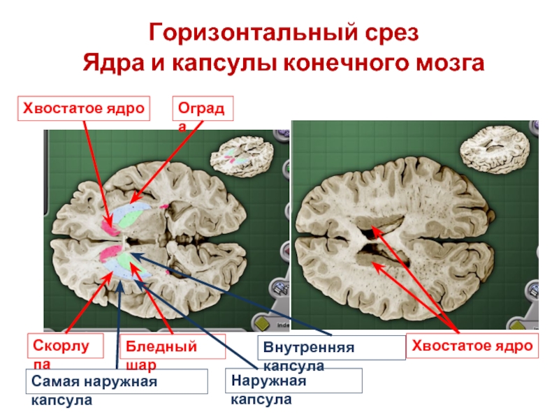 Ядра мозга образованы. Хвостатое ядро скорлупа бледный. Скорлупа базальные ядра. Наружная капсула базальных ядер. Внутренняя капсула конечного мозга.