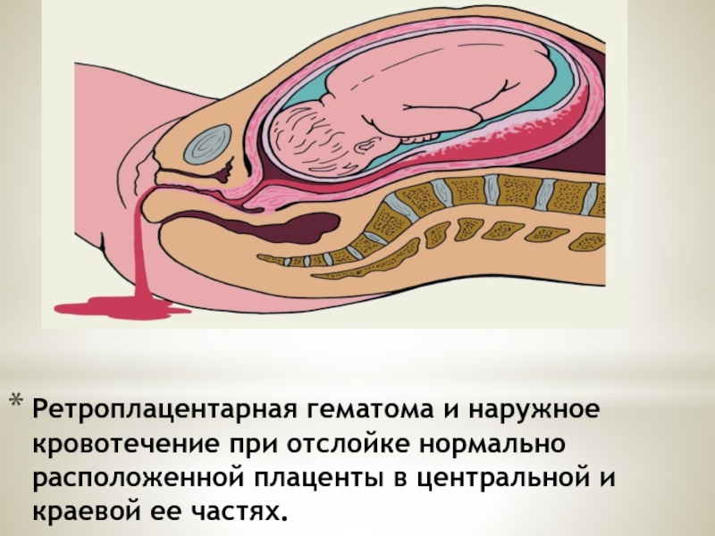 Ретроплацентарная гематома и наружное кровотечение при отслойке нормально расположенной плаценты в центральной
