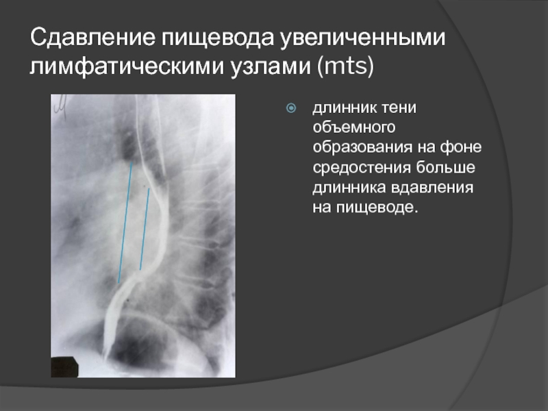 Стенка пищевода образует складки за счет