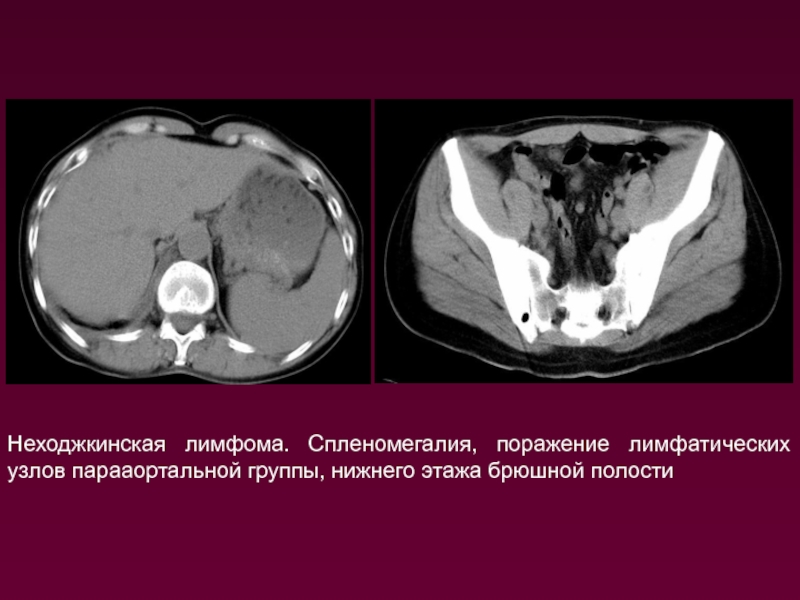 Неходжкинские лимфомы. Лимфома брюшной полости на кт. Лимфома брюшной полости на мрт.