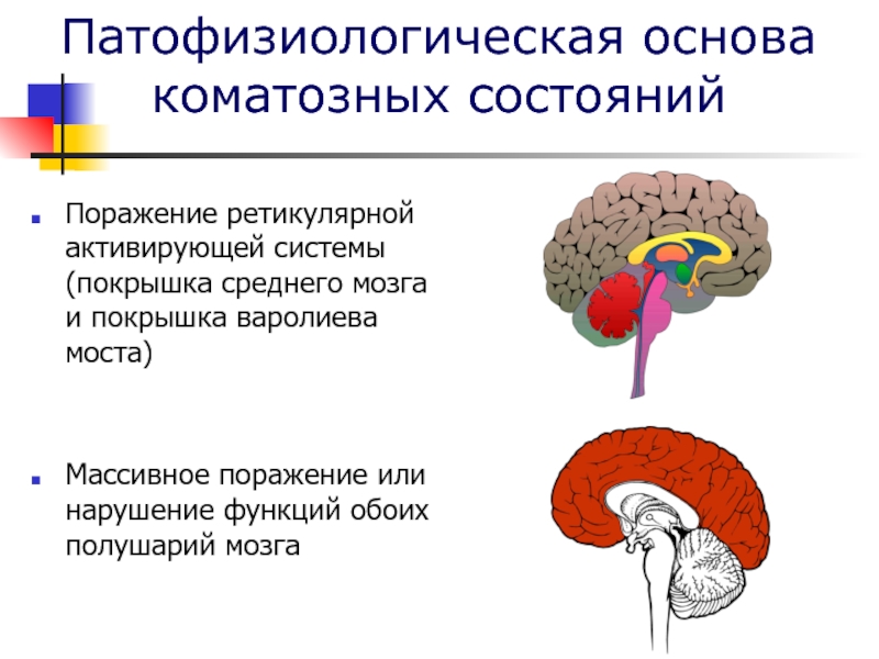 Патофизиологическая основа коматозных состоянийПоражение ретикулярной активирующей системы (покрышка среднего мозга и