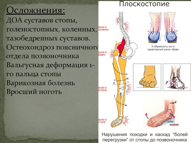 Диагноз доа суставов. Деформирующий остеоартроз осложнения. Осложнения деформирующего остеоартроза. Осложнения деформирующего остеоартроза коленного сустава.