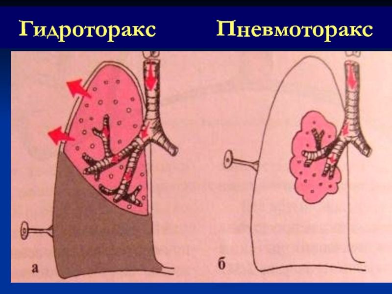 Гидроторакс карта вызова