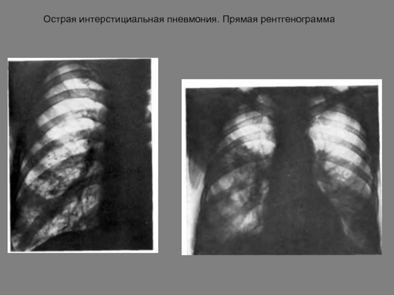 Полисегментарная пневмония. Интерстициальная пневмония рентген. Интерстициальная пневмония на рентгенограмме. Интерстициальная пневмония у детей рентген. Нетипичная интерстициальная пневмония.