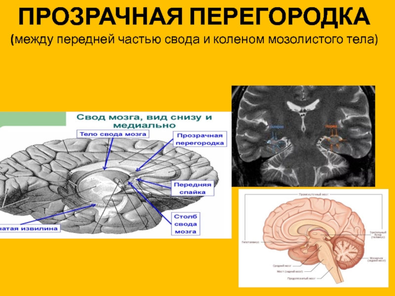 Прозрачная перегородка мозга. Свод мозга и прозрачная перегородка. Свод мозолистое тело и прозрачная перегородка. Столбы свода головного мозга. Свод мозга анатомия.