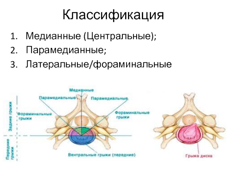 Парамедианная грыжа позвоночника. Парамедианная экструзия. Медианно-парамедианная билатеральная грыжа. Классификация межпозвонковых грыж. Медианно-парамедианная грыжа l5-s1.