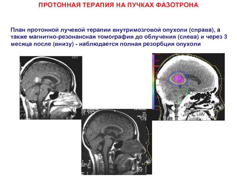 Лучевая терапия опухолей головного мозга презентация