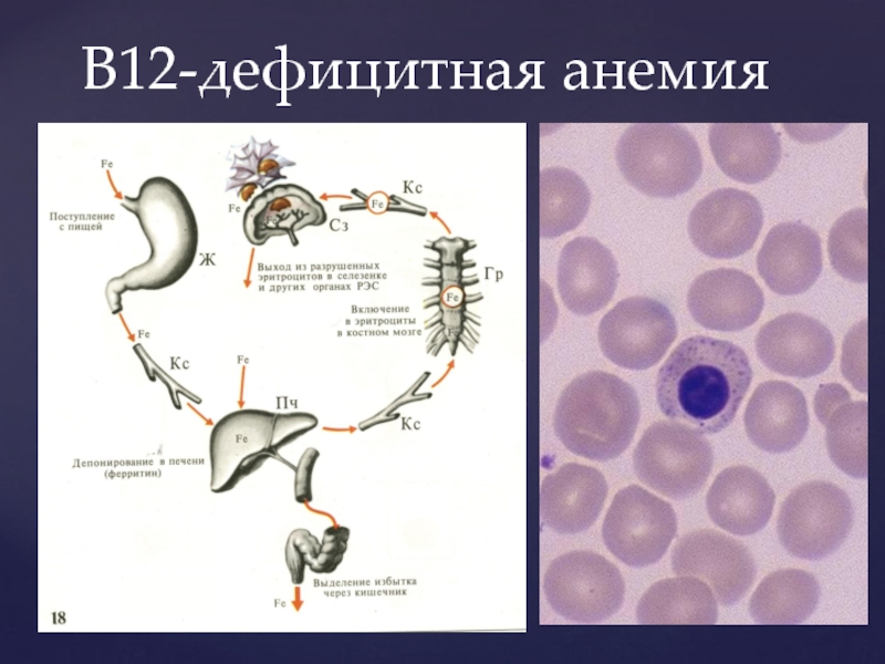 Фолиевая дефицитная анемия презентация