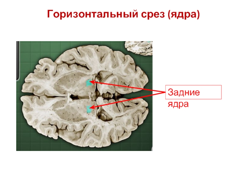 Фронтальный срез. Горизонтальный срез общества. Аксиальный и фронтальный срез. Фронтальный срез улитки.