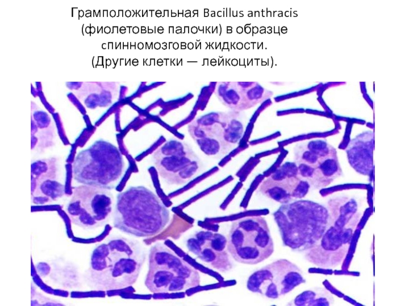 Грамположительная Bacillus anthracis (фиолетовые палочки) в образце cпинномозговой жидкости.  (Другие клетки — лейкоциты).