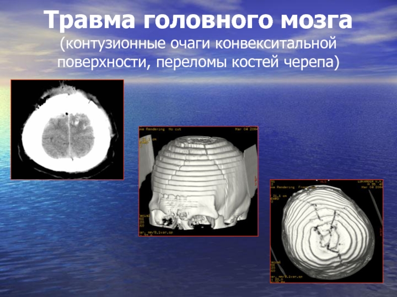 Травма головного мозга (контузионные очаги конвекситальной поверхности, переломы костей черепа)