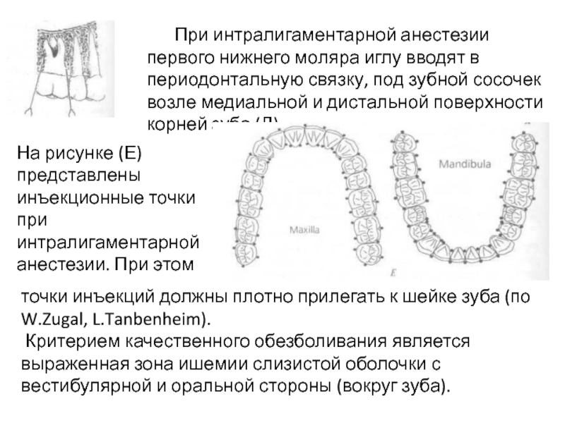 Интрасептальная анестезия