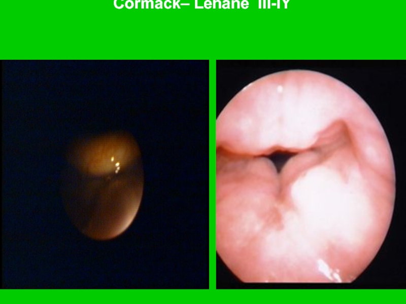 Cormack– Lehane III-IY