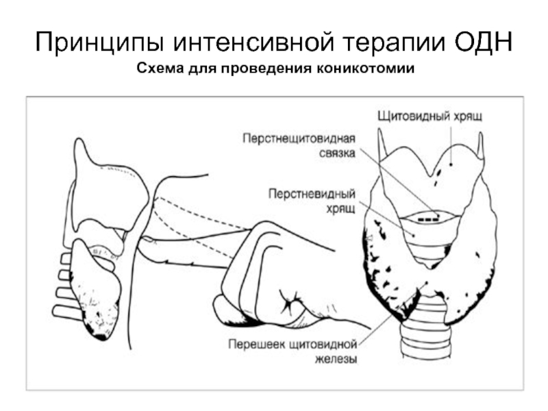 Острая дыхательная недостаточность презентация реанимация