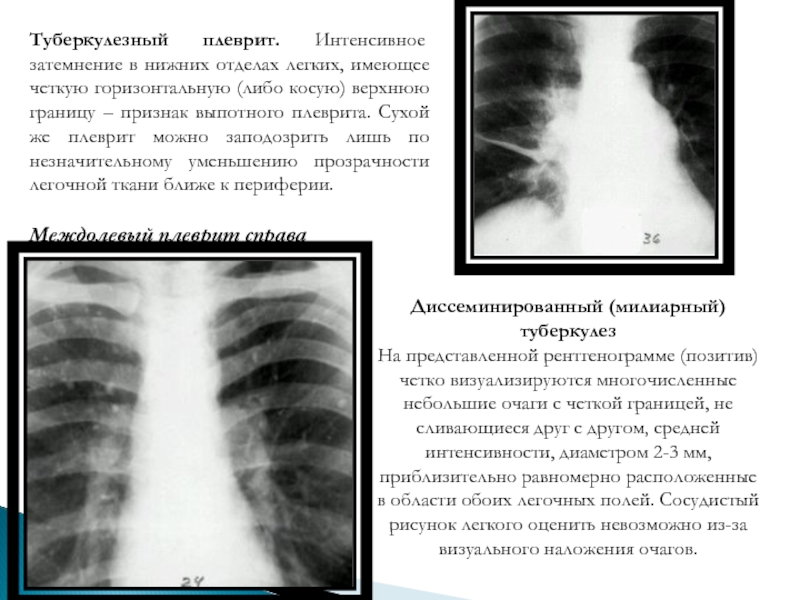 Затемнение нижних легких. Туберкулезный плеврит рентген. Туберкулезный сухой плеврит рентген. Туберкулезный экссудативный плеврит рентген.