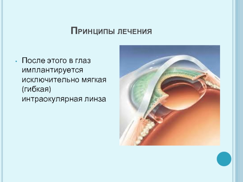 Интраокулярные линзы презентация