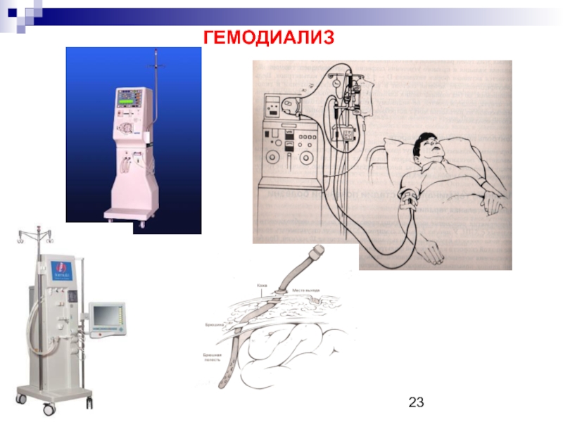 Фистула искусственная