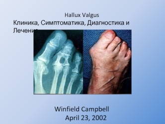Hallux Valgus
Клиника, Симптоматика, Диагностика и Лечение 








Winfield Campbell
April 23, 2002