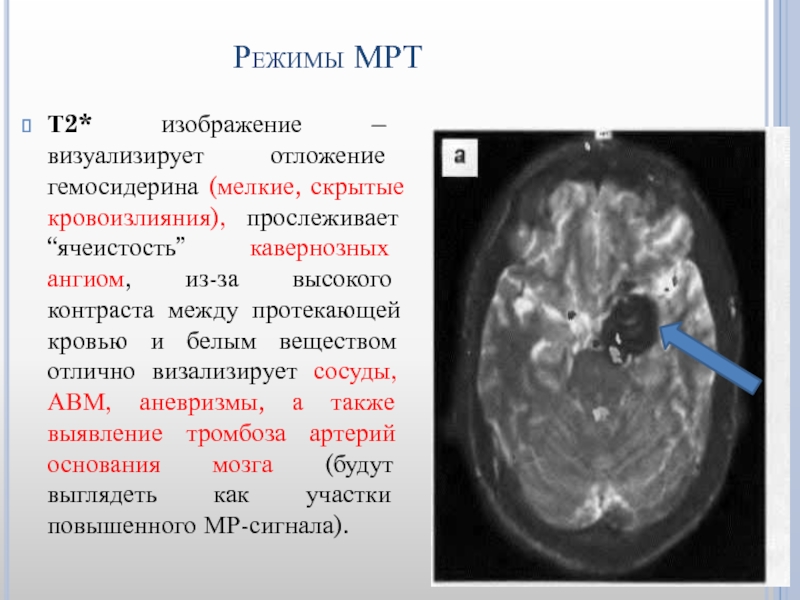 Т1 и т2 взвешенные изображения в мрт