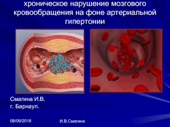 Хроническое нарушение мозгового кровообращения на фоне артериальной гипертонии