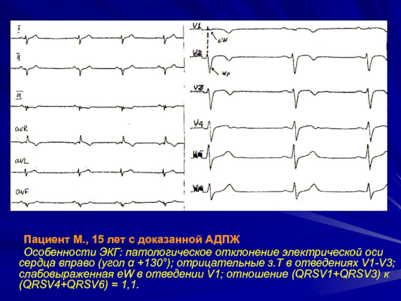 Патологии экг презентация