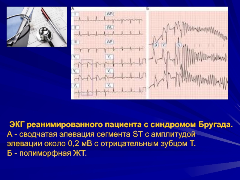 Синдром бругада на экг фото