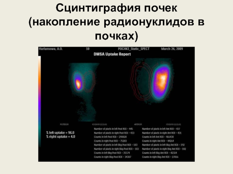 Доклад: Сцинтиграфия почек