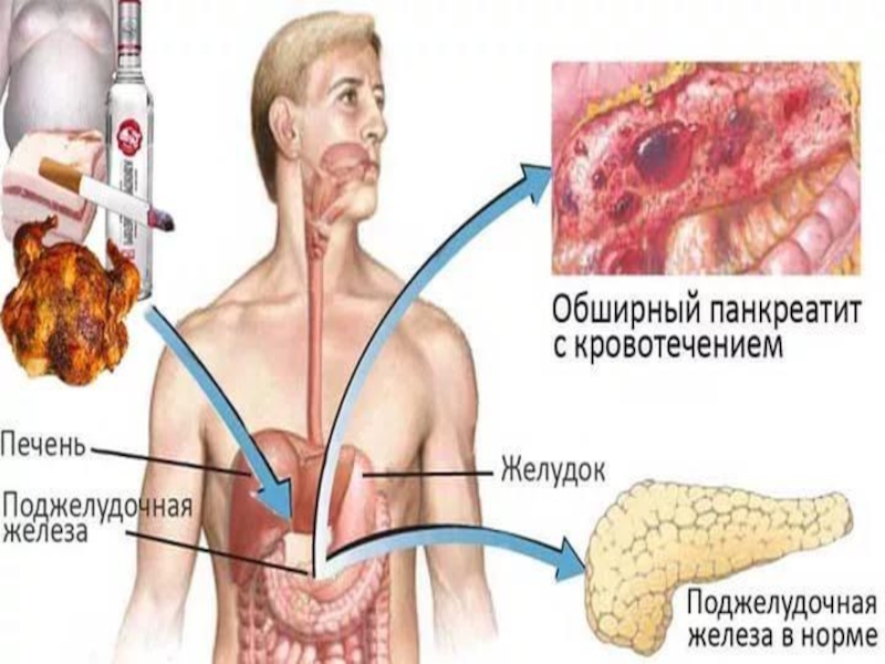 Что такое некроз поджелудочной железы у мужчин. Панкреатит и панкреонекроз. Панкреатит поджелудочной железы.