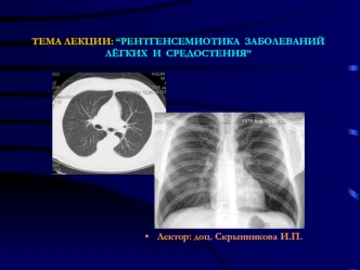 Рентгенсемиотика заболеваний лёгких и средостения