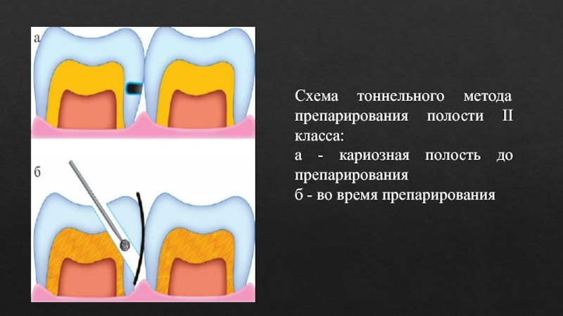 Придесневая стенка в полостях v класса препарируется под углом