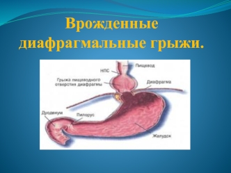 Врожденные диафрагмальные грыжи